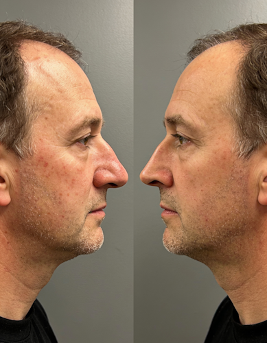 rhinoplasty toronto featured